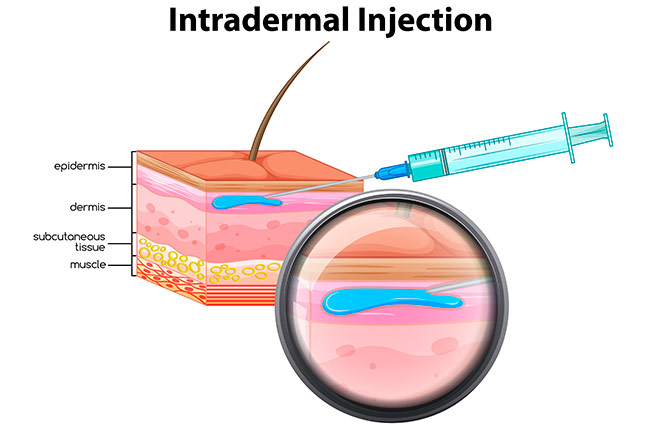 Intradérmica injeção